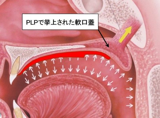 鼻咽腔閉鎖不全の口腔装置治療 PLP