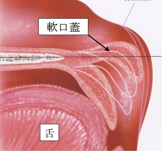 鼻咽腔閉鎖不全の口腔装置治療 PLP
